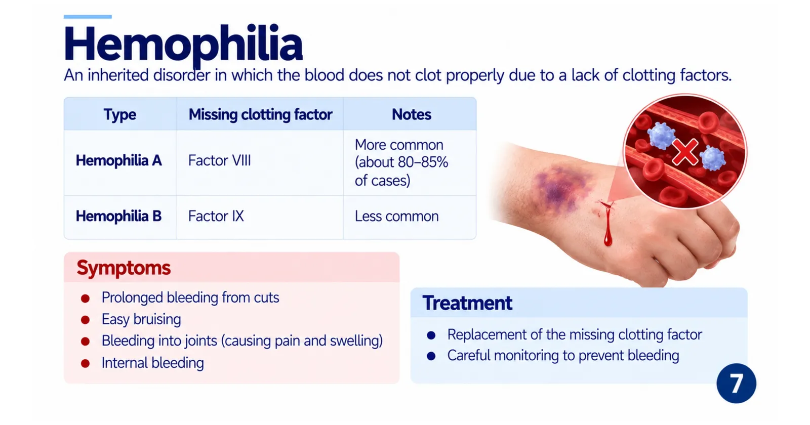 Haemophilia: haemophilia A lacks factor VIII and haemophilia B lacks factor IX, with symptoms such as prolonged bleeding and bleeding into joints