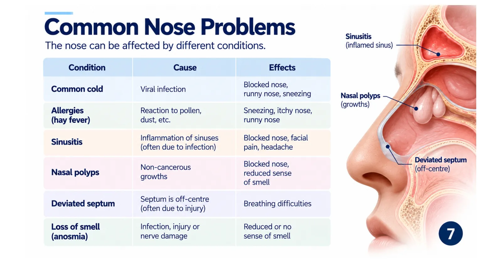 Common nose problems table: common cold, allergies (hay fever), sinusitis, nasal polyps, deviated septum and loss of smell (anosmia), with their causes and effects